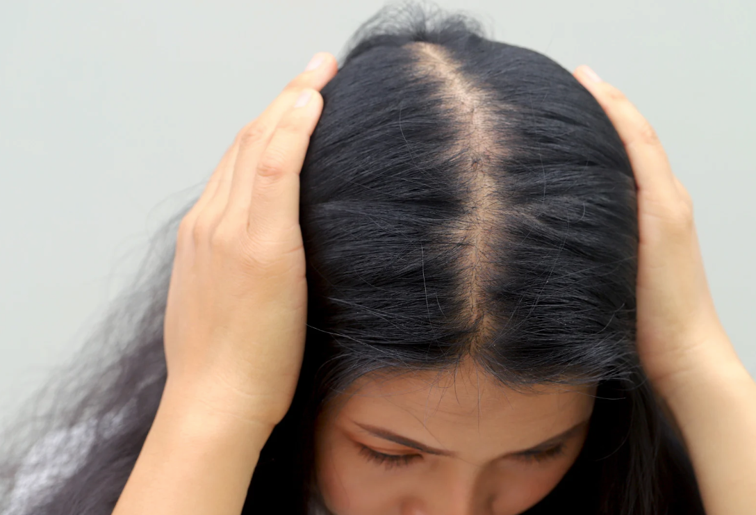 How Chronic Stress Affects the Scalp and Hair-Growth Cycle